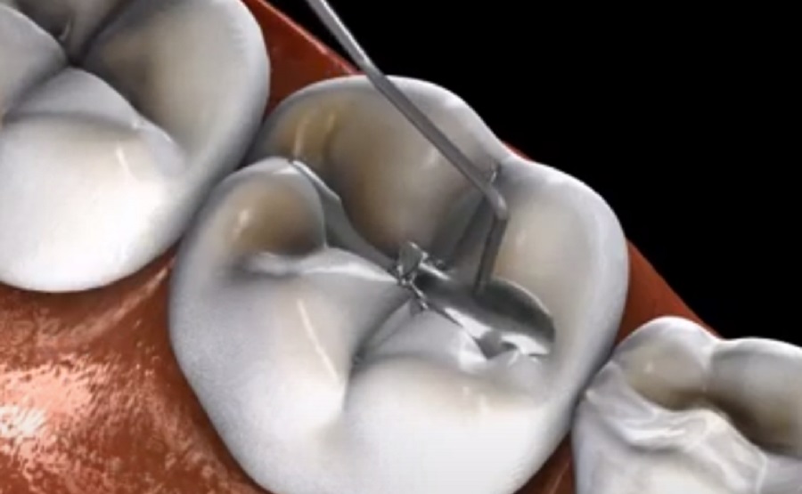 A fogkövet el kell távolíttatni, mert komoly gondokat okozhat