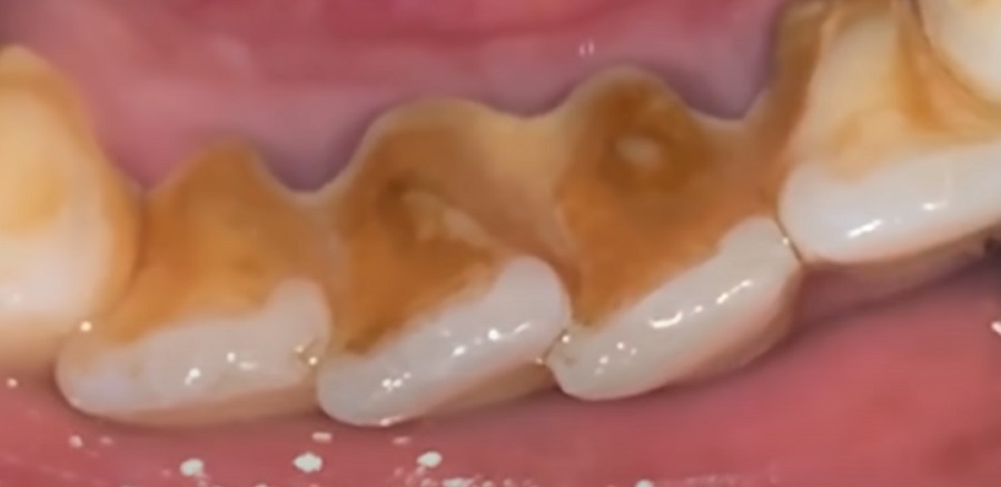 Így néz ki a fogkő a fogak tövében