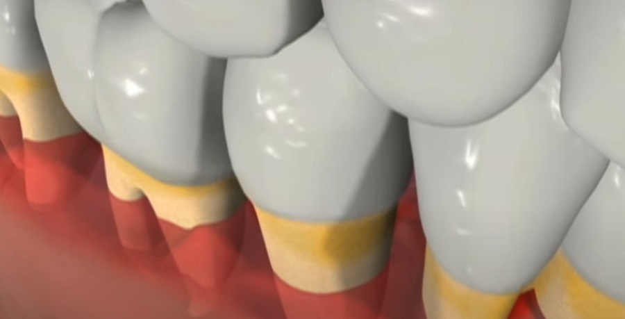 Van esély a periodontális betegségek visszafordítására? 