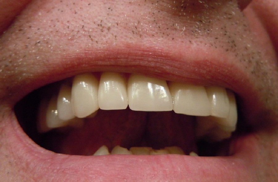 Átmeneti megoldások léteznek a fogproblémákra - de mielőbb fogorvoshoz kell fordulni