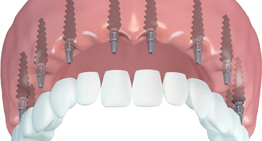 reform_dental_torzs1_javitott