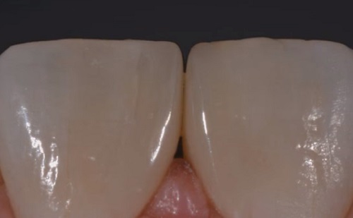 Mit tehetünk a fogcsikorgatás ellen? 