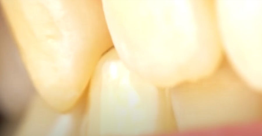 A fogak összeszorítása és csikorgatása egyre gyakoribb probléma