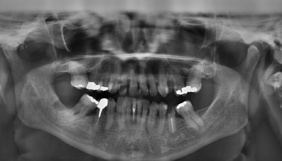 Algoritmus segíthet megjósolni, kinél nagyobb a fogak elvesztésének esélye