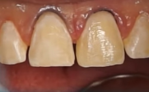 Miért alakul ki rés a fogak között? 