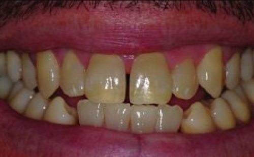 Hogyan javítható a fogak közti rés?