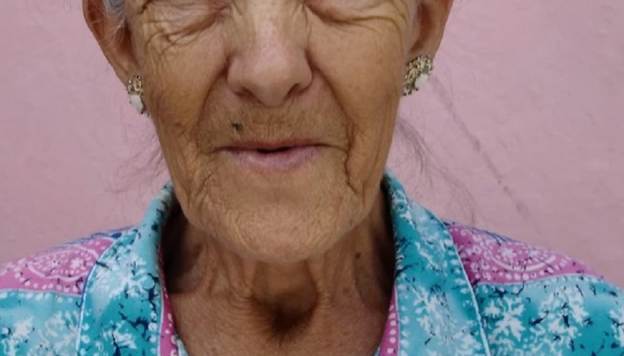El riesgo de demencia por pérdida de dientes aumenta en los ancianos