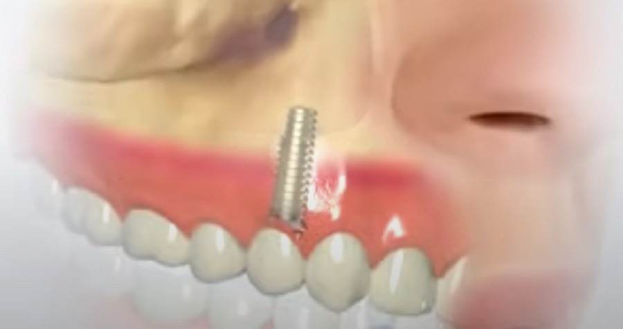 A fogimplantátum behelyezése érzéstelenítés alatt minimális kellemetlenséggel jár