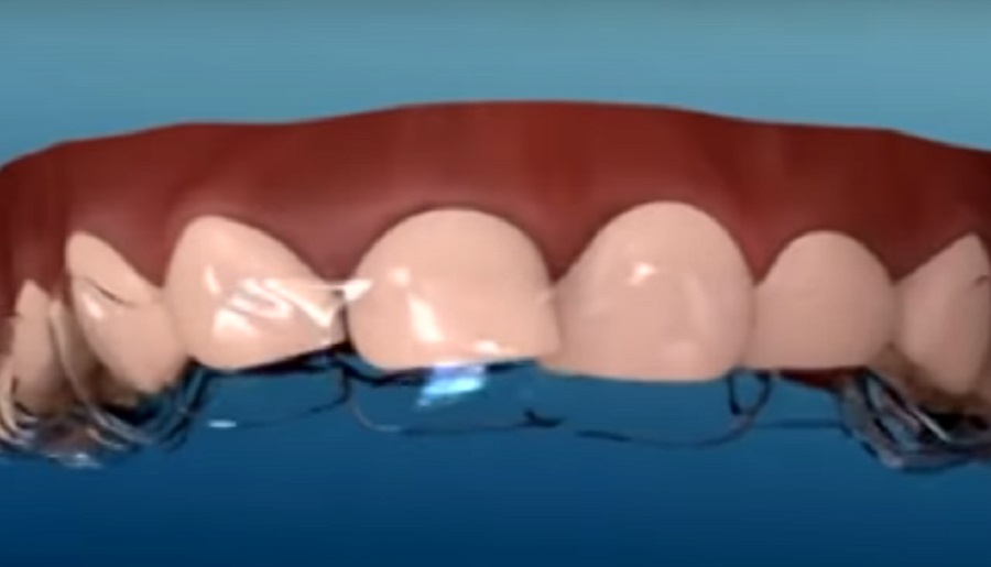 Hatékony és láthatatlan alternatíva a fogkorrekcióra az Invisalign