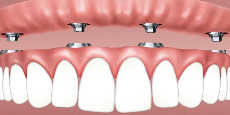 Bizonyos körülmények között nagy szükség lehet a fogimplantátumokra