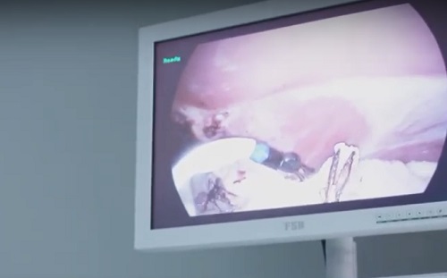 Mesterséges intelligencia - Méheltávolító műtéteknél is megjelent a robot