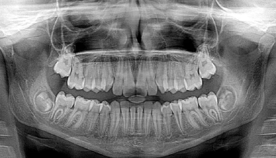 Új technika született annak megértésére, miként károsítja a sav a fogakat mikrostrukturális szinten
