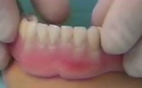 Meglepő plusz előnnyel is jár a fogimplantátum