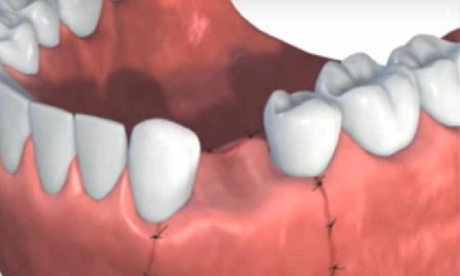 A fogimplantátum felületei jelentős szerepet játszanak a szövetek rögzítésében, elűzik a nemkívánatos baktériumokat