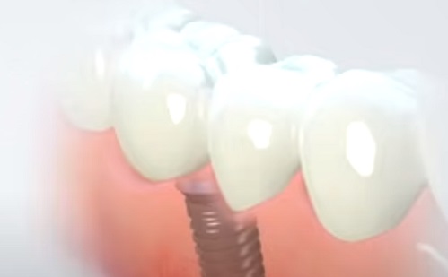 Ellenállnak a baktérium-szaporodásnak az okos fogászati implantátumok