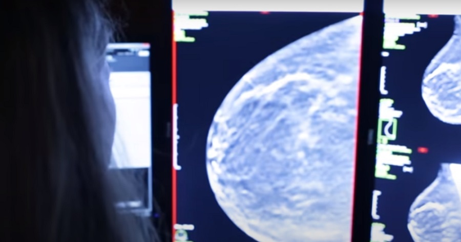 A mammográfia pontossága terén még van mit fejlődnie a mesterséges intelligenciának