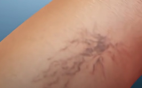 Kinek való eljárás az ambuláns flebektómia?