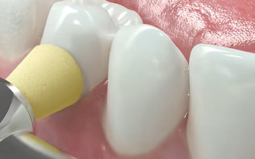 Csúcstechnológia - Egyszer használatos polírozók tehetik szebbé a fogakat