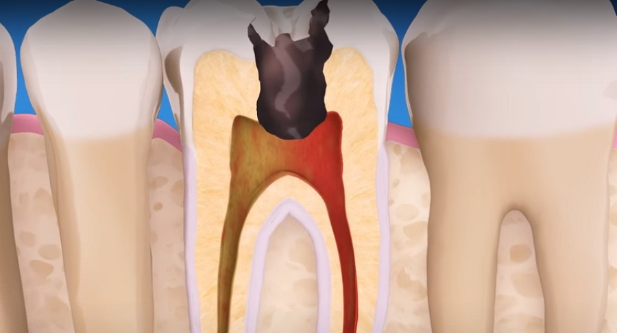 Gyökérkezelés – Érdekes dolog derült ki a fogak túléléséről
