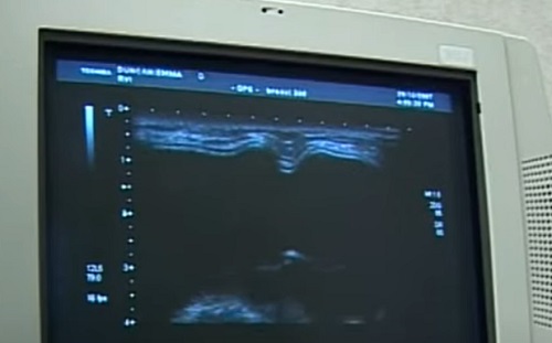 Mellrák diagnosztika - Mást lát az orvos és a mesterséges intelligencia?