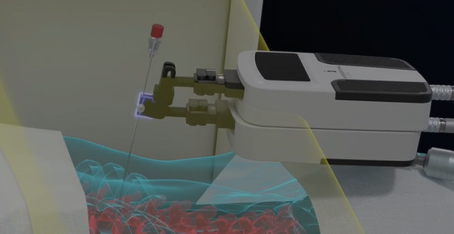 Engedélyt kapott a világ egyik legkisebb perkután sebészeti robotja