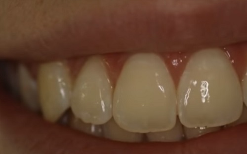 A periodontitis és az erekciós diszfunkció szív- és érrendszeri problémákat von maga után