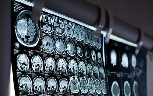 Mesterséges intelligencia működik a stroke-ellátásban Budapesten is
