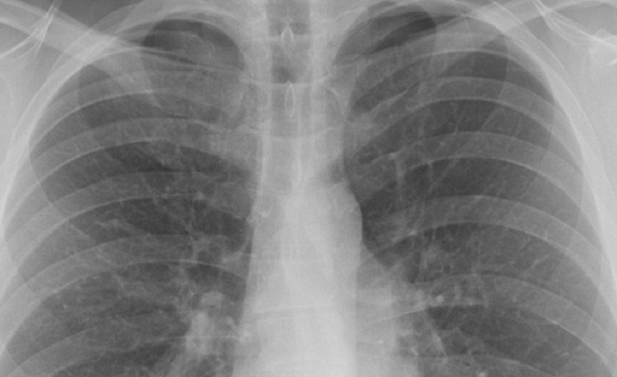 Tüdődiagnosztika - Enyhítheti a kórházak túlterheltségét a mesterséges intelligencia