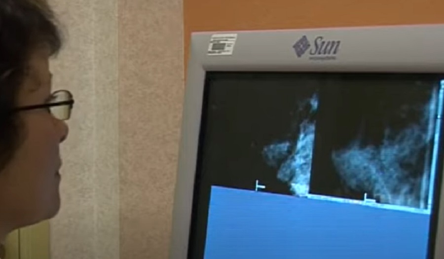 Javíthatja a mellrákszűrés pontosságát a mesterséges intelligencia 