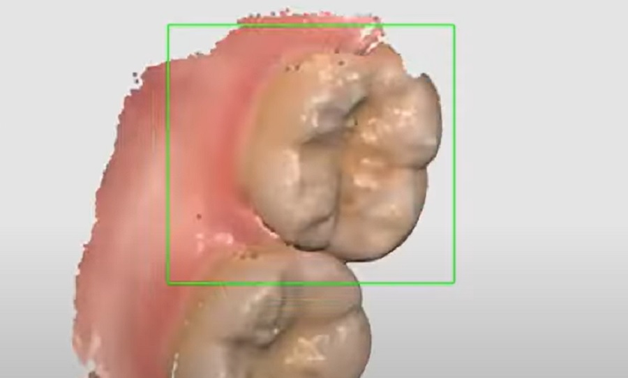 Új normává válik a 3D nyomtatás a fogászatban