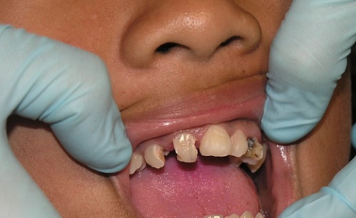 Agyzsugorodást is okozhat, ha nem figyelünk oda a fogainkra