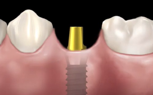 Mi a szövetszintű fogimplantátum és mik az előnyei?