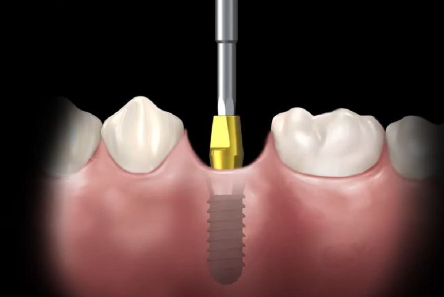 Számos előnnyel jár a szövetszintű fogimplantátum
