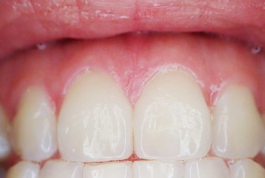 A fogíny színe különféle egészségügyi állapotok korai jelzőjeként szolgálhat