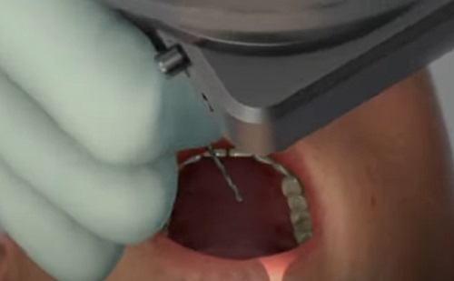 A 10 ezredik implantátum-beültetését ünnepli a Yomi robot