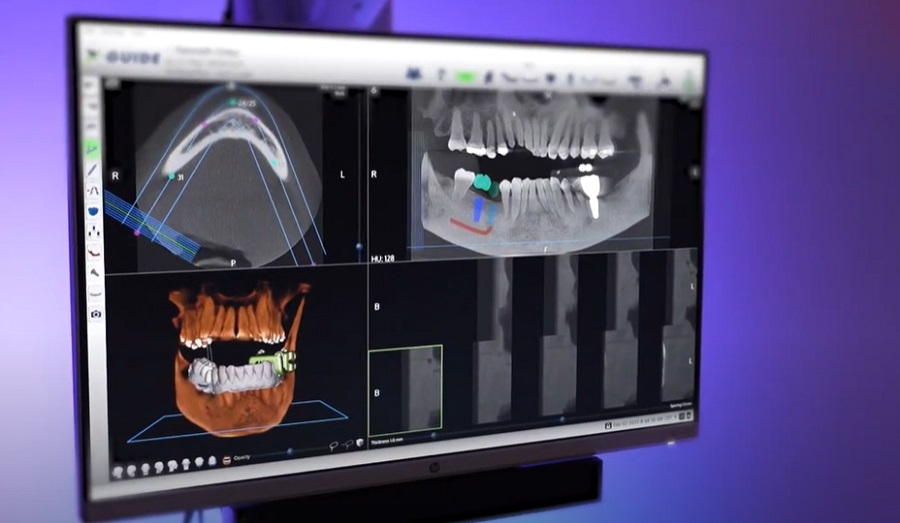 Nem teljesen állandó fogakkal távozunk egynapos fogászati implantátumnál, de a mosolyunk szép lesz