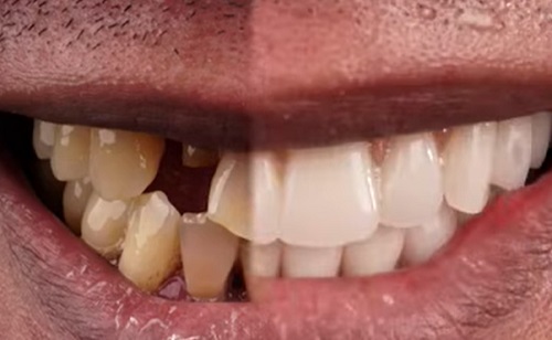 Az arc deformálódását is gátolja a fogászati implantátum