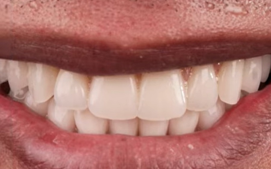 A fogászati implantátumok nemcsak kozmetikai megoldást nyújtanak