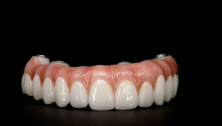 Melyek az egynapos fogászati implantátum előnyei és hátrányai?