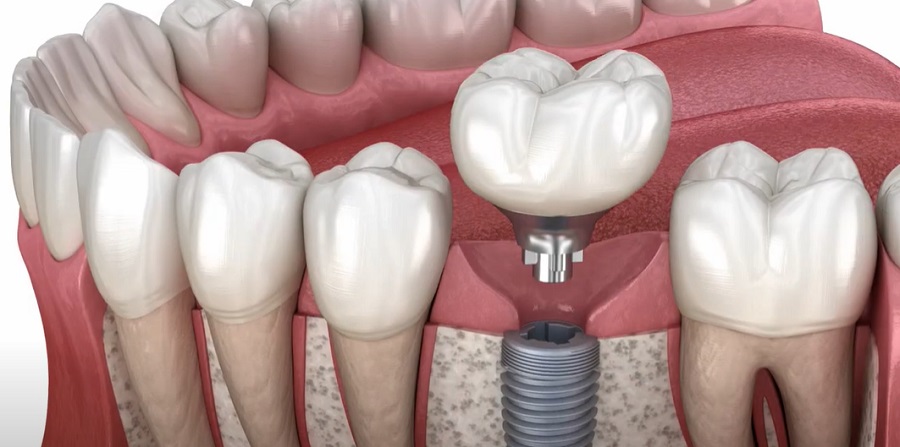 Az egynapos fogászati implantátumoknak is több típusa van