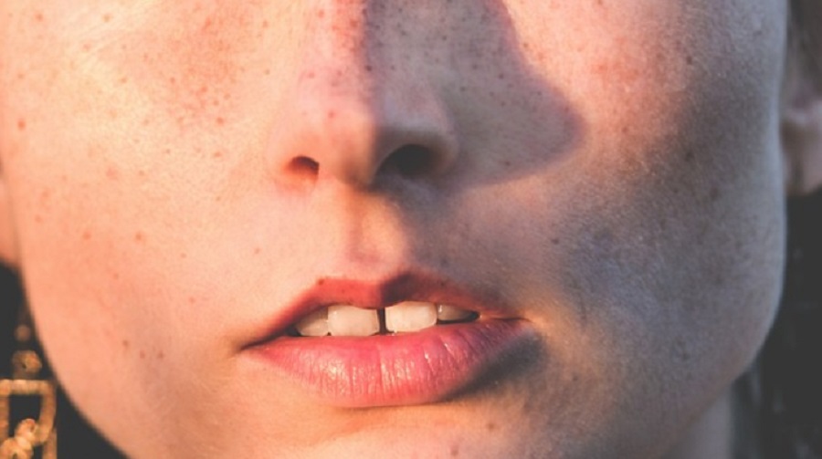 A csontvesztés és az arc megereszkedése is esélyes fogászati implantátum nélkül