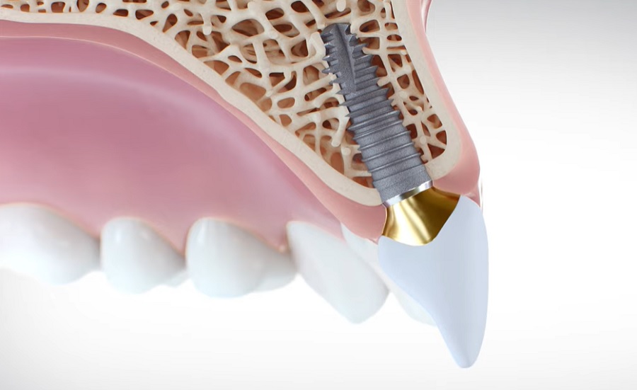 A fogászati implantátumok tartósak és olyanok, mint a valódi fogak