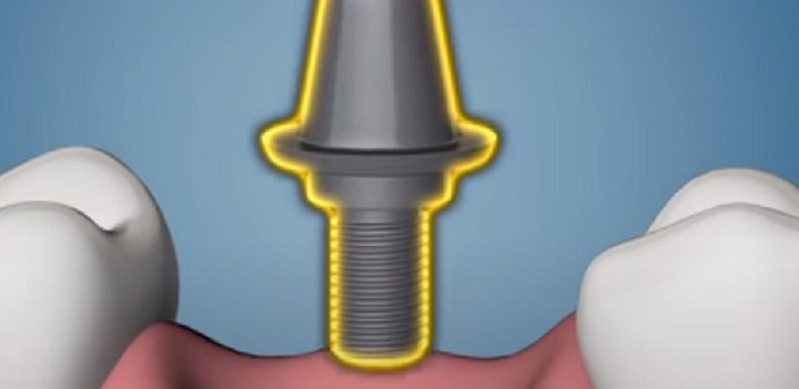 Ezeket a gondokat mind megoldja a fogászati implantátum