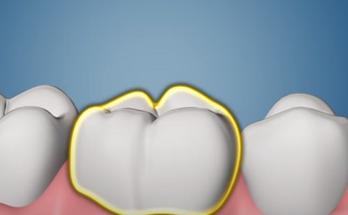 Intő jelek, hogy fogászati implantátumra van szükségünk - 1.rész