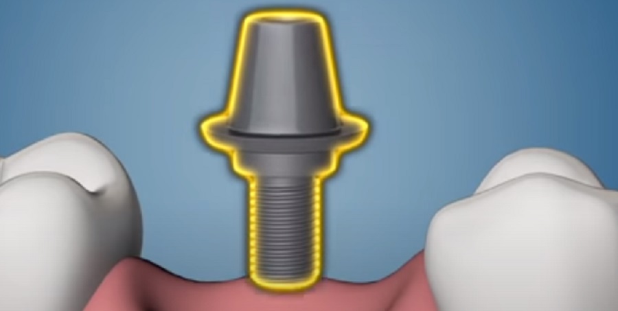 Számos problémát orvosolnak a fogászati implantátumok