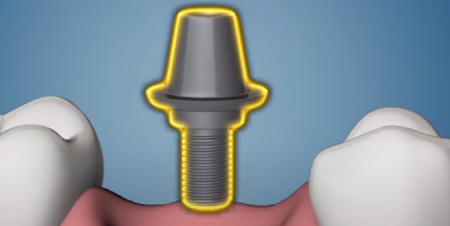 A fogászati implantátum beültetéséből számos előnyünk származik