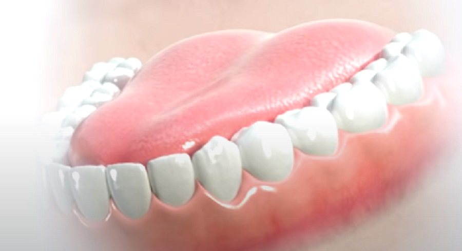 Számos okunk van arra, hogy szükség esetén fogászati implantátumot készíttessünk