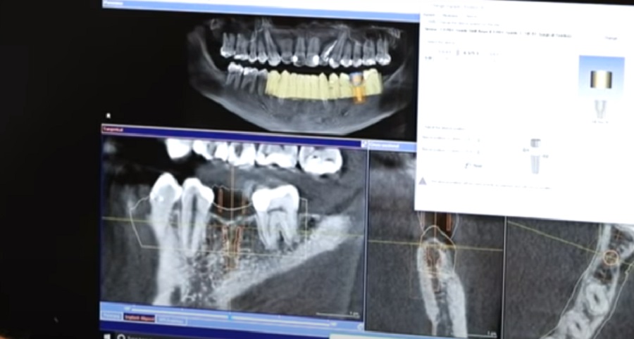 Fogimplantátum előtt - Hagyjuk ki a röntgent, készítsünk CT-vizsgálatot