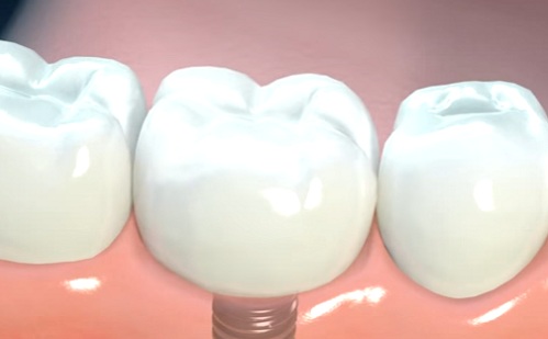 Ezeket a gondokat mind megoldja a fogászati implantátum 