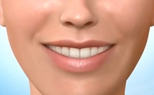 Az 5 top dolog, amiért népszerű a fogászati implantátum